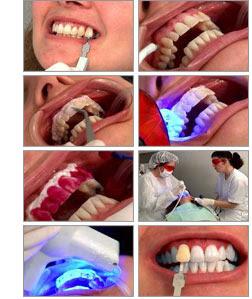 Blanqueamiento dental por tan solo $250.000